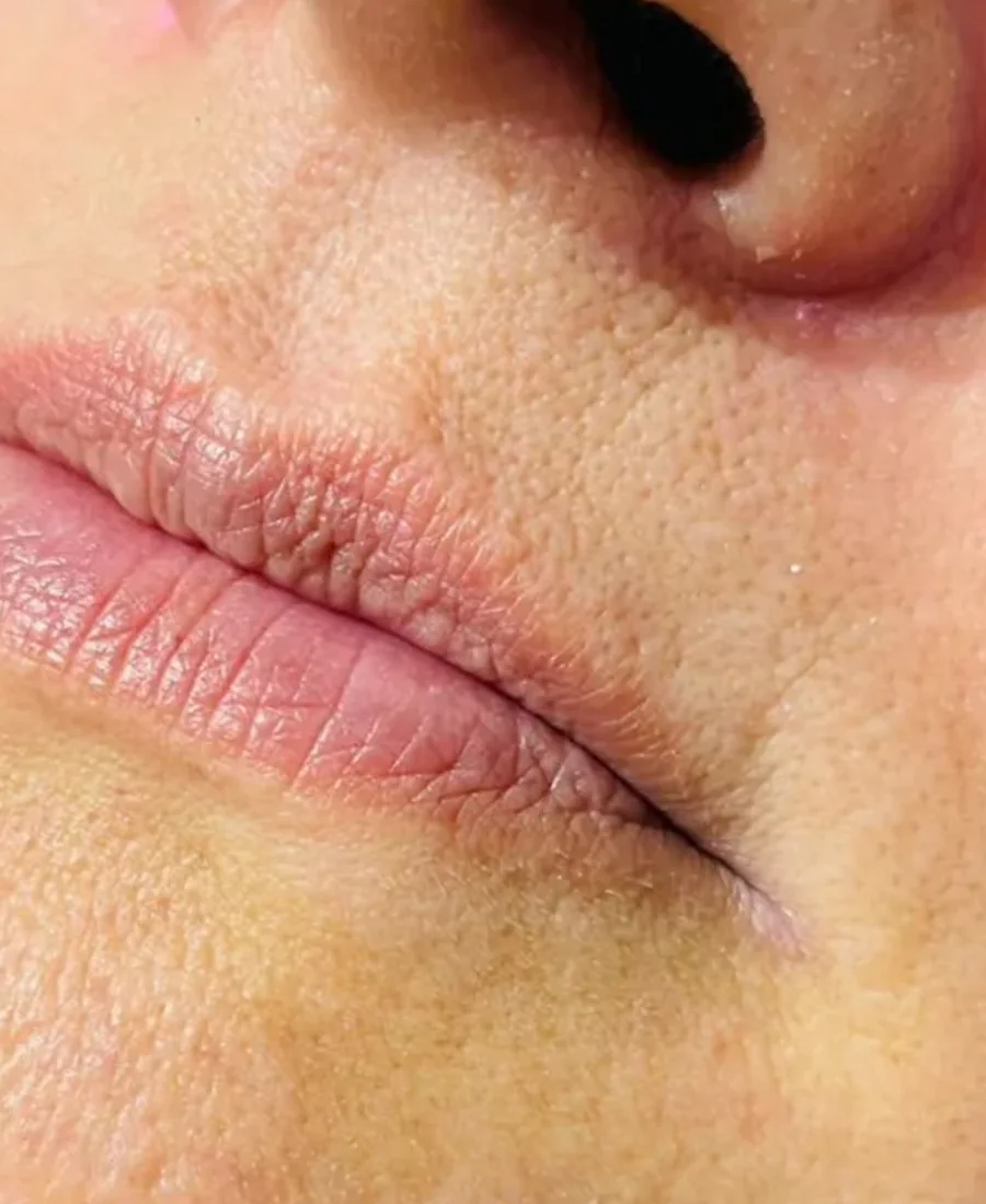 Antes: preenchimento labial