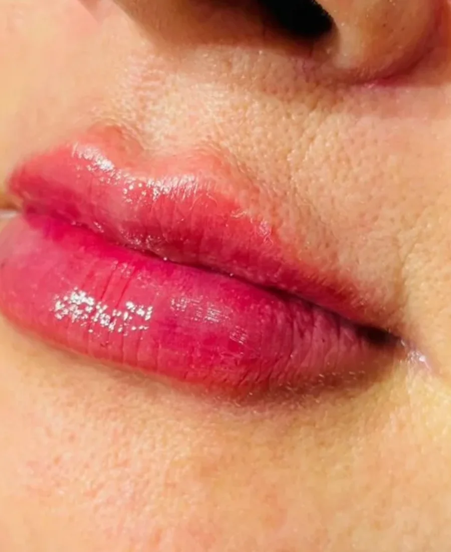 Depois: preenchimento labial