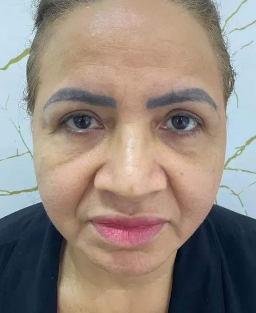 Antes: malar e prp nas olheiras