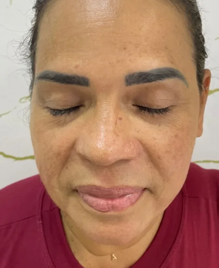 Antes: prp, olheiras e bigode chinês