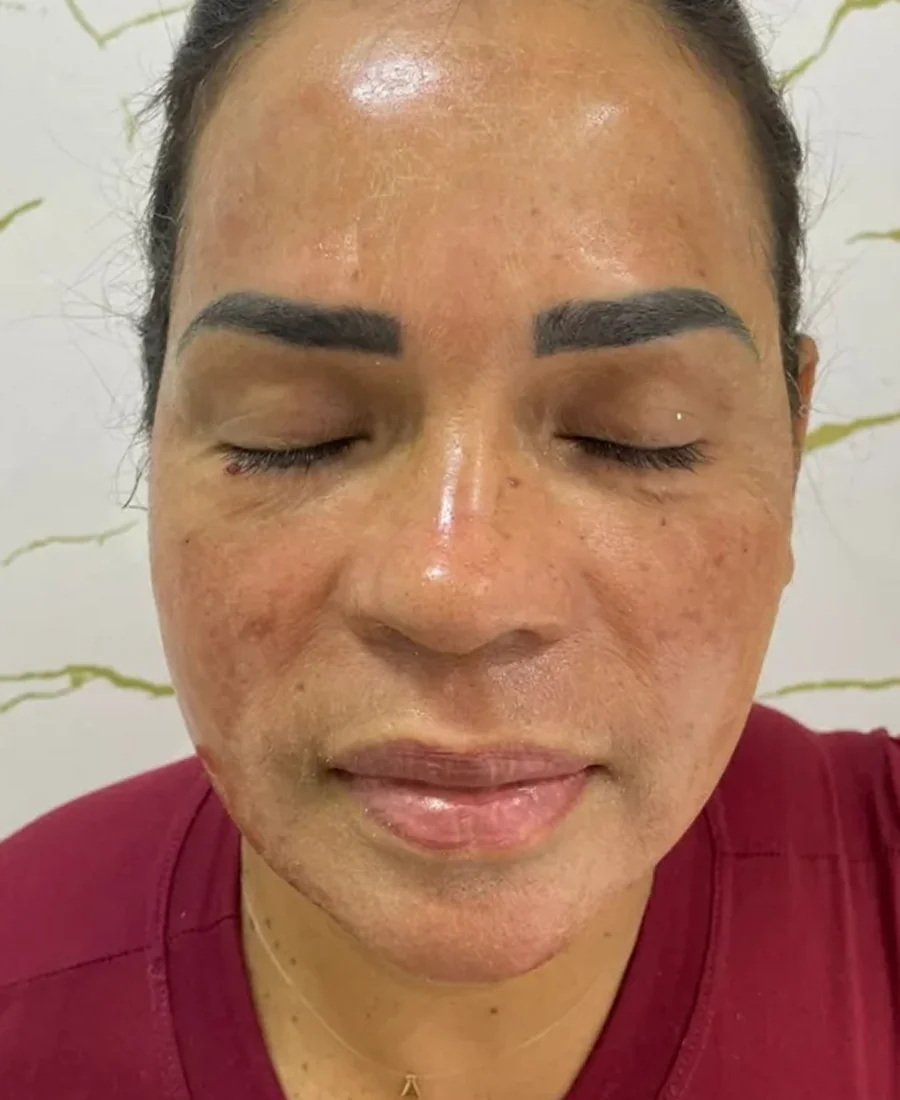 Depois: prp, olheiras e bigode chinês